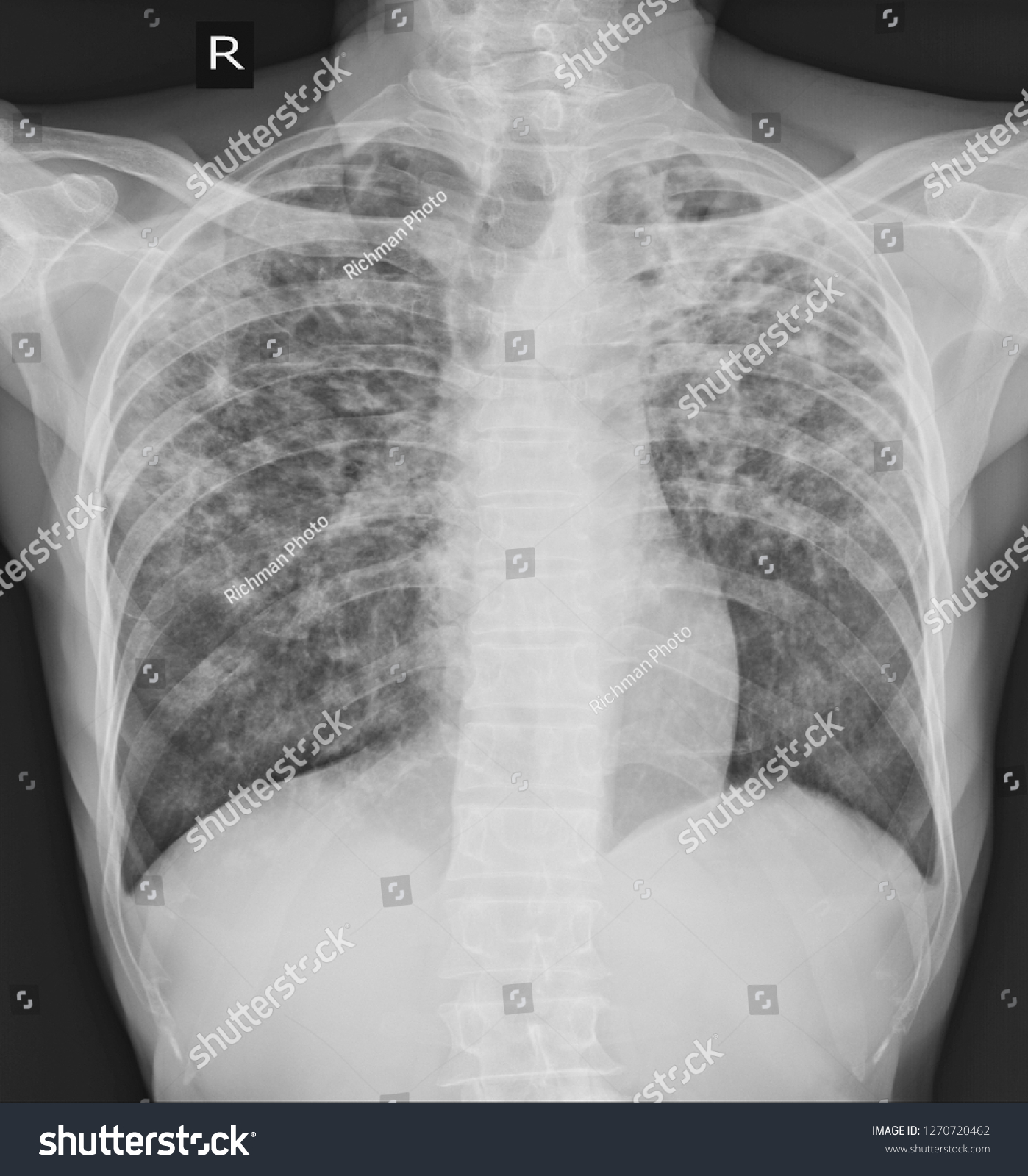 Pulmonary Tuberculosis Tb Chest Xray Old Stock Photo Edit Now 1270720462
