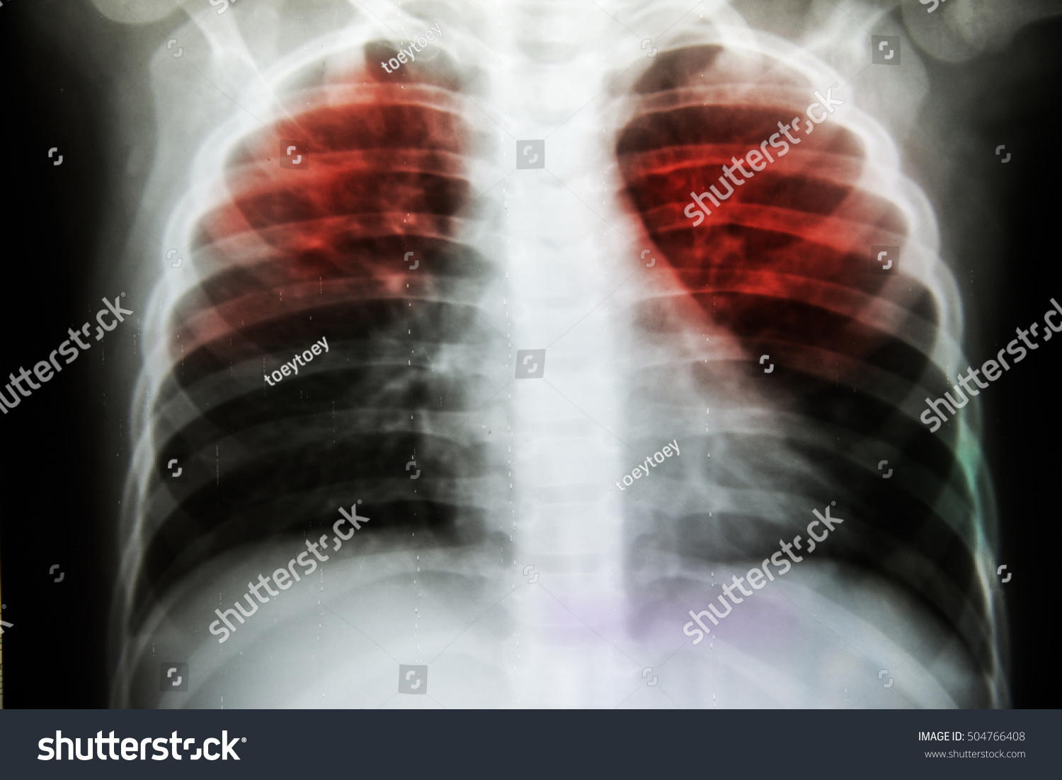 Pulmonary Tuberculosis Tb Chest Xray Show Stock Photo 504766408 ...