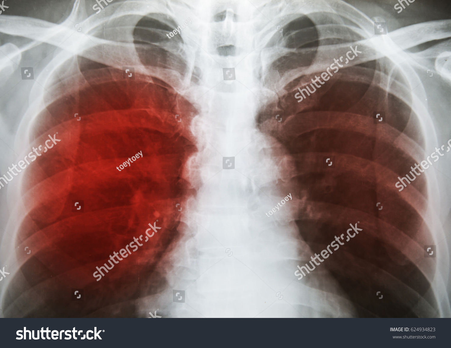 Pulmonary Tuberculosis Tb Chest Xray Show Stock Photo 624934823 ...