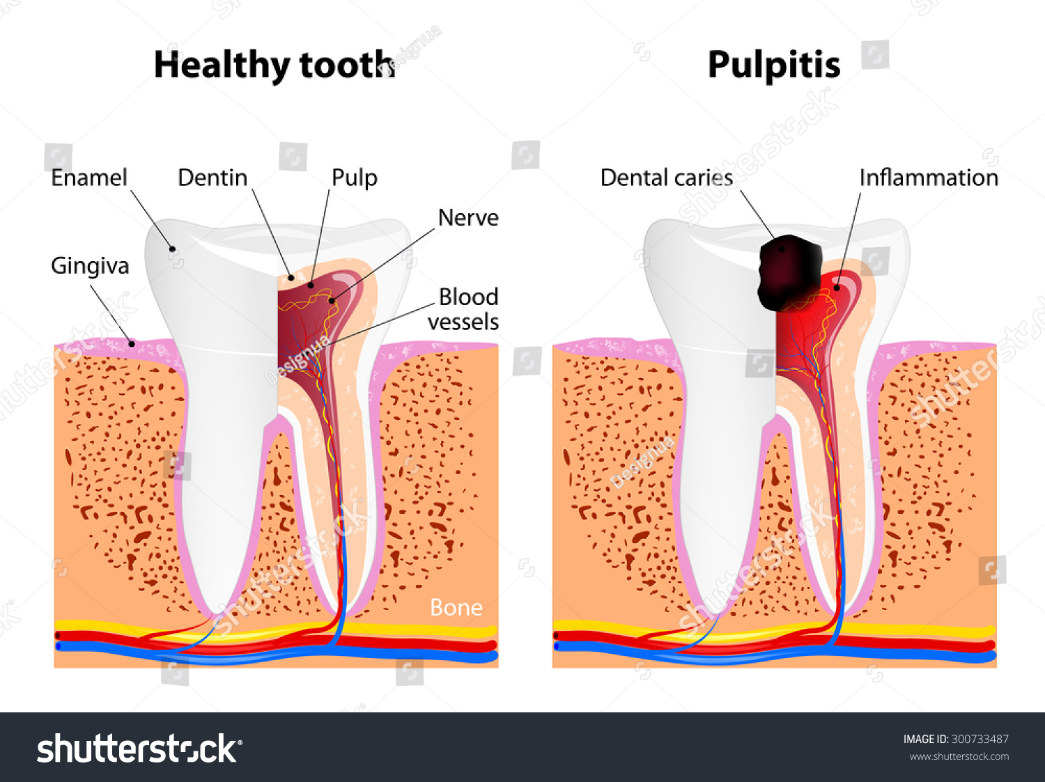 Pulpitis And Healthy Tooth Stock Photo 300733487 ... dental pulp diagram 