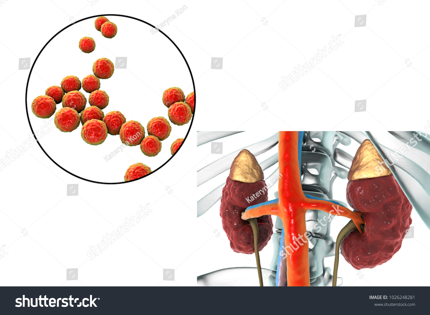 Pyelonephritis Medical Concept Closeup View Bacteria Stock Illustration ...