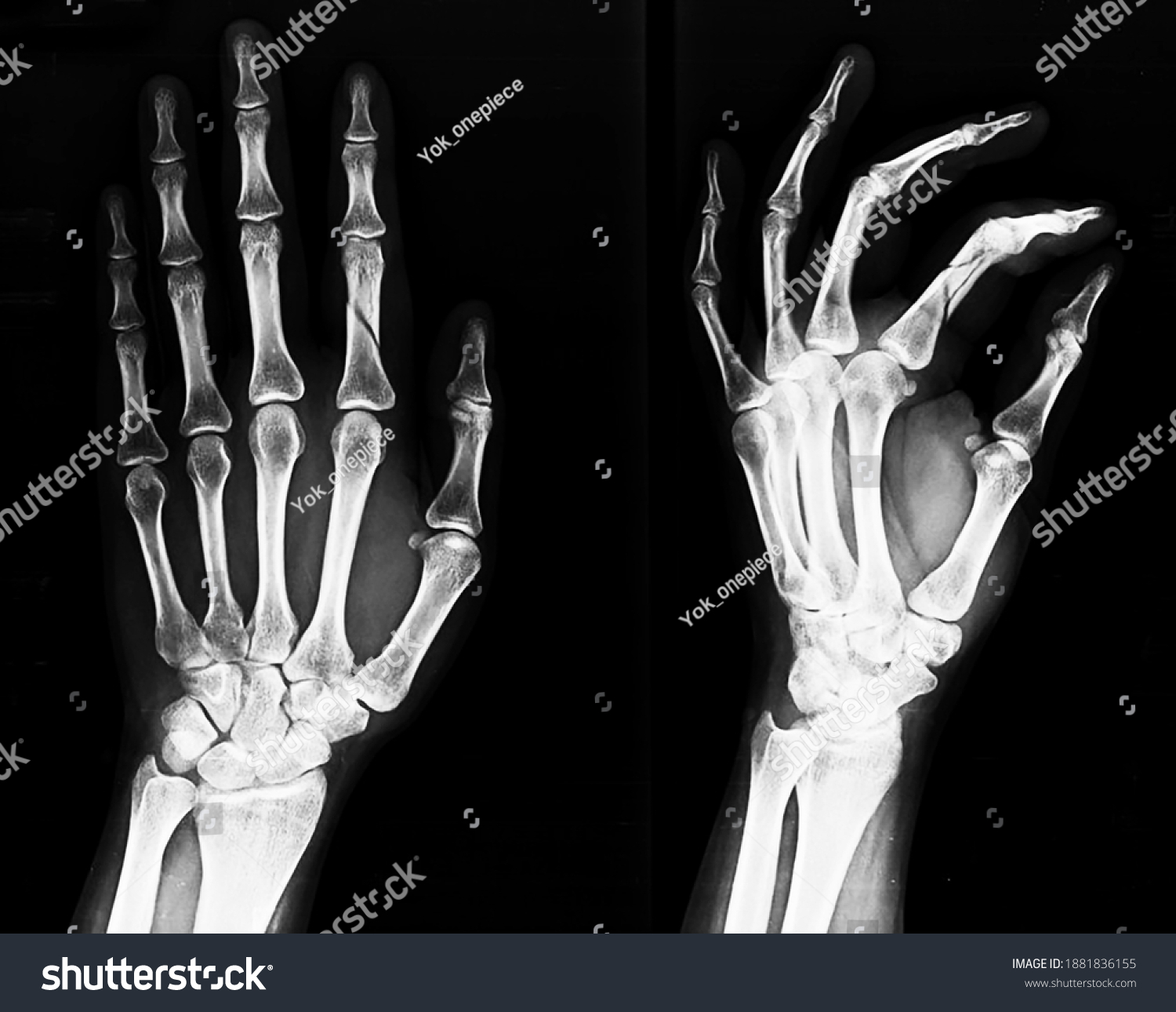 Radiographic Images Hand Showing Closed Fracture Stock Photo (Edit Now ...