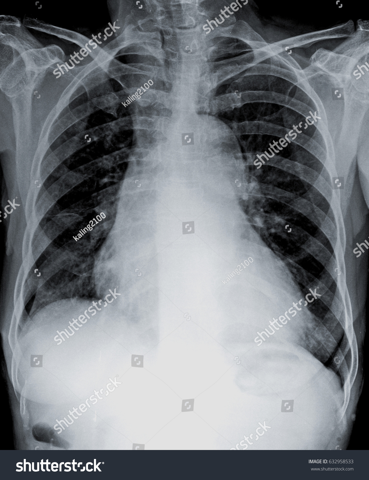 Radiography Chest Enlarged Heart Shadow Stock Photo (Edit Now) 632958533