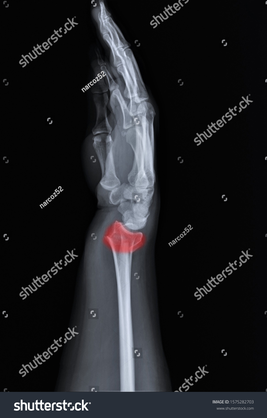 Radiography Forearm Wrist Bones Fracture Distal Stock Photo (Edit Now ...