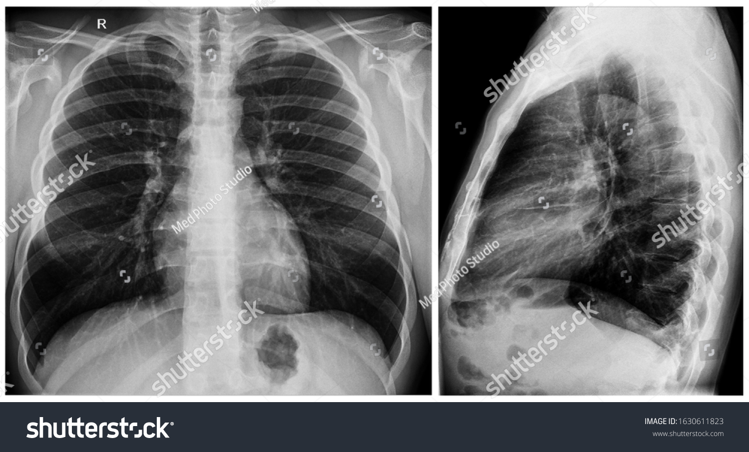 Radiography Xray Film Human Chest Lungs Stock Photo 1630611823 ...