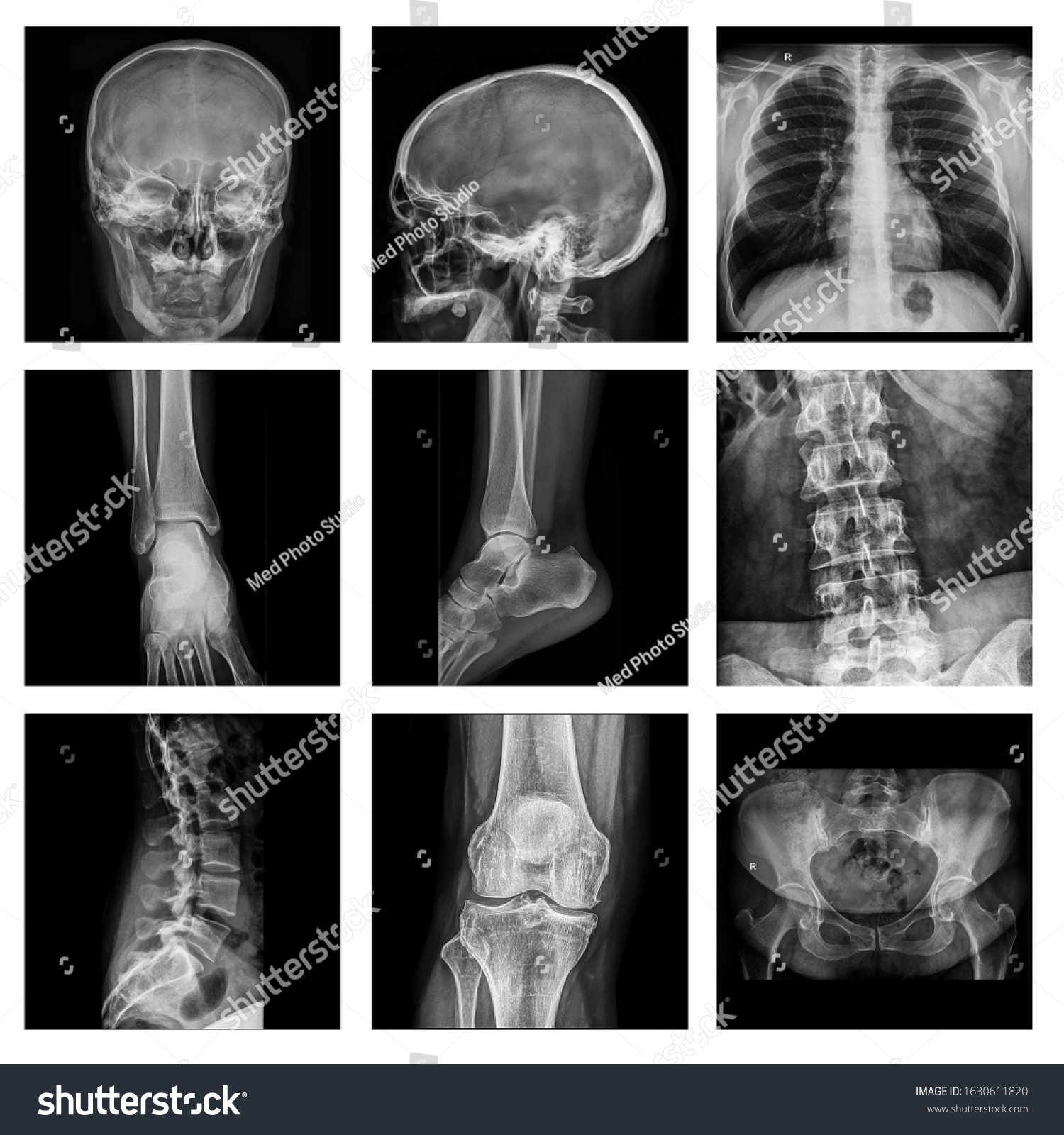 Radiography Xray Film Human Chest Skull Stock Photo 1630611820 ...