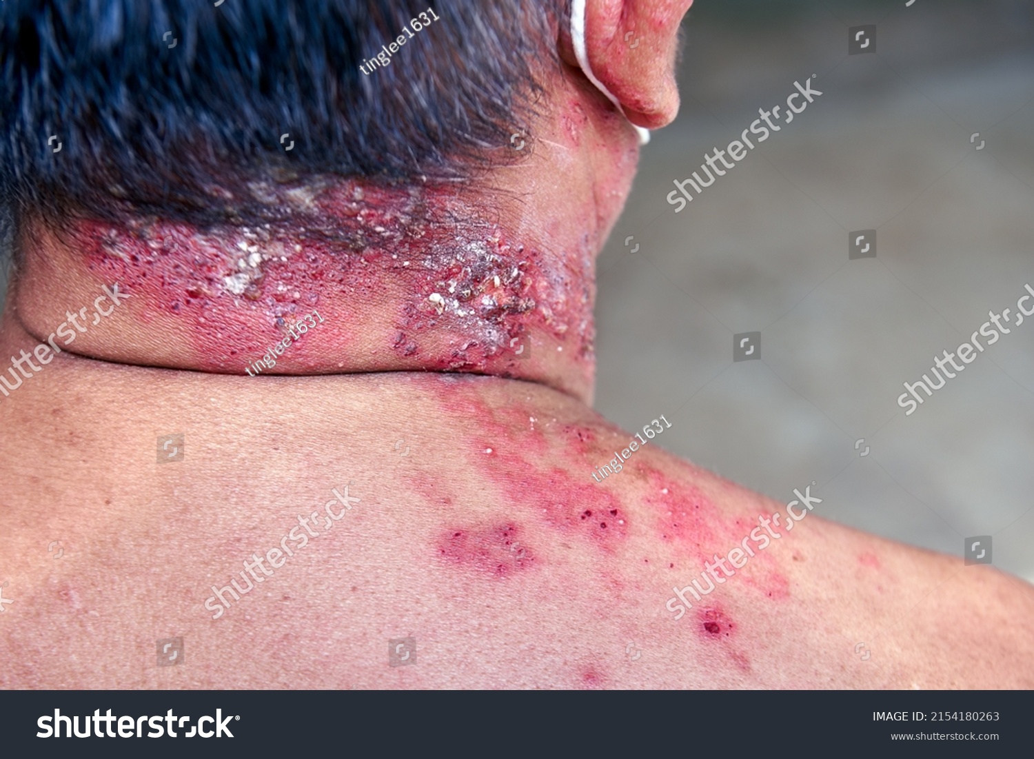 Raised Red Bumps Skin Rash Blisters Stock Photo 2154180263 | Shutterstock