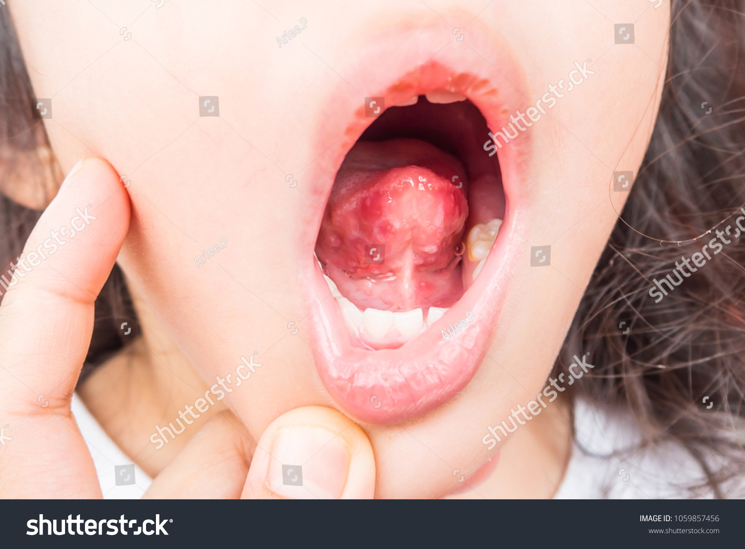 white-spots-in-mouth-images-stock-photos-vectors-shutterstock