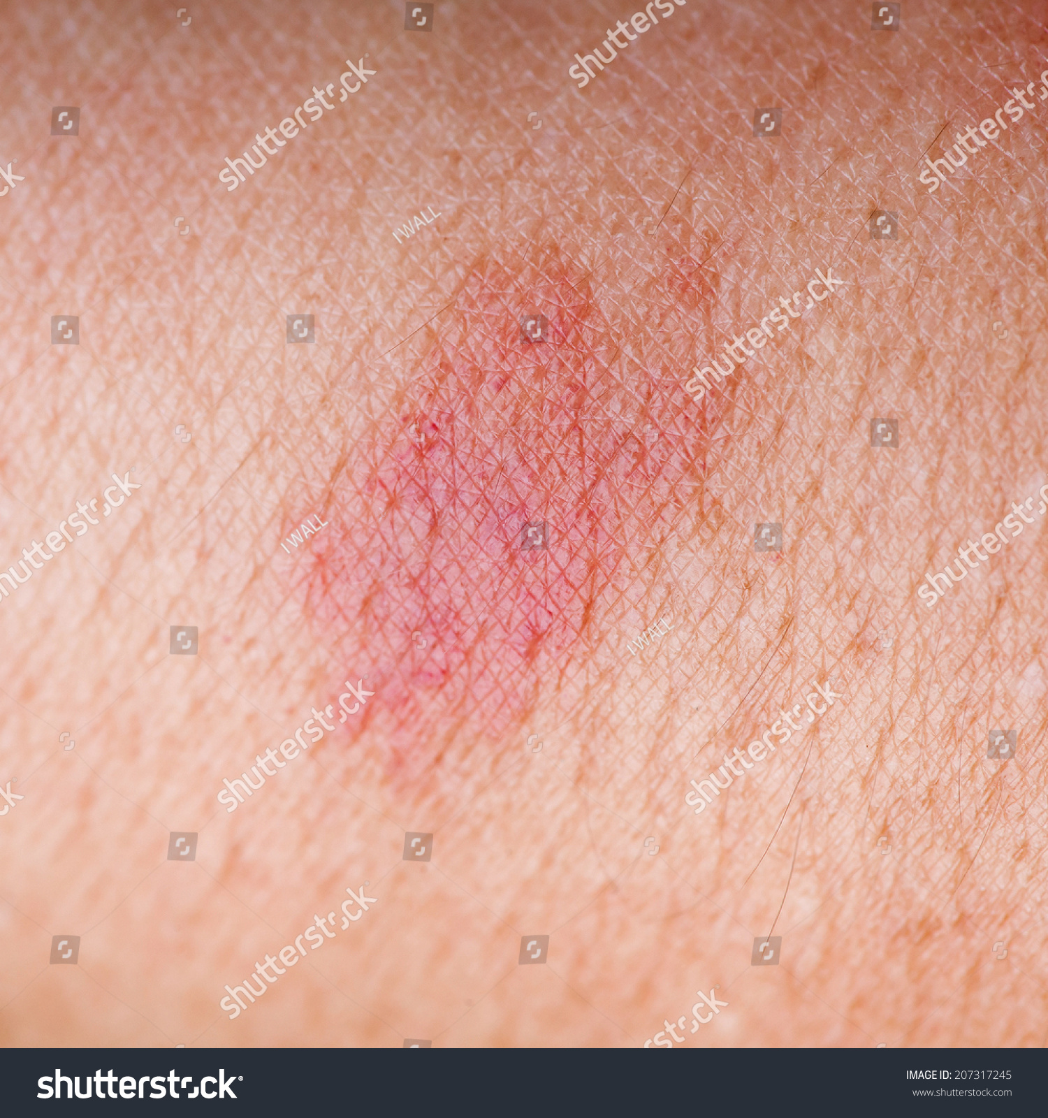 Red Birthmark Stock Photo 207317245 - Shutterstock