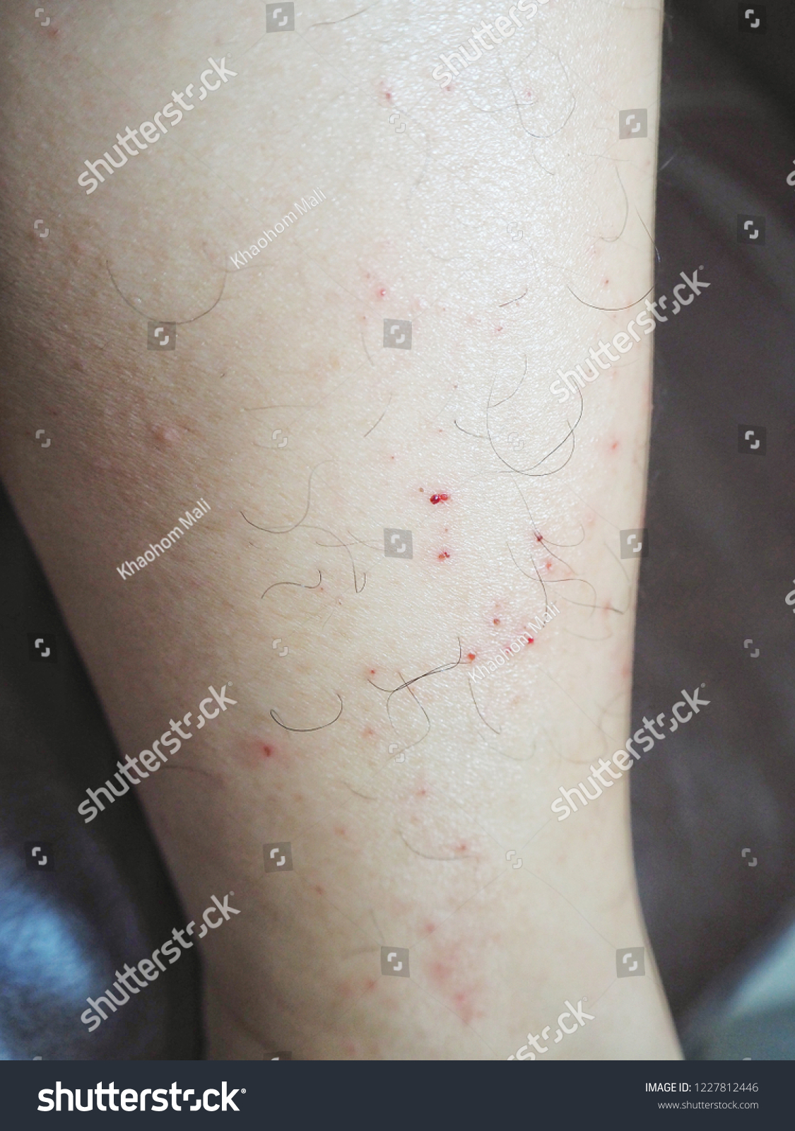 red-spot-on-leg-scratching-itching-stock-photo-1227812446-shutterstock