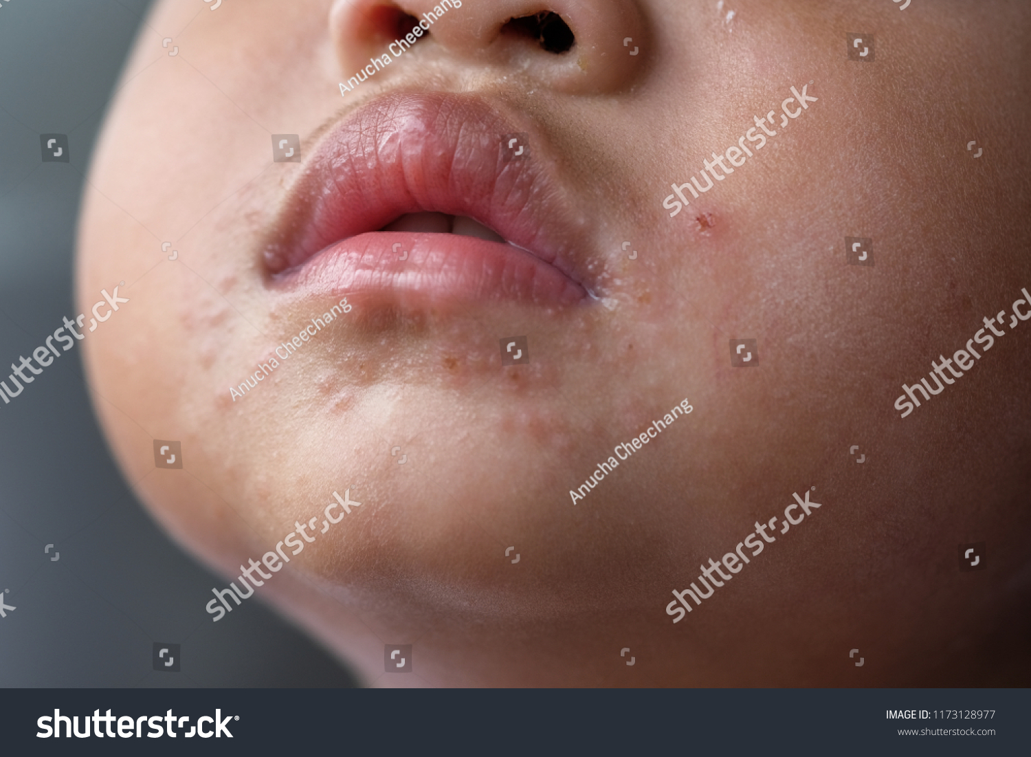 Red Spot On Mouth Hand Foot Stock Photo Edit Now 1173128977