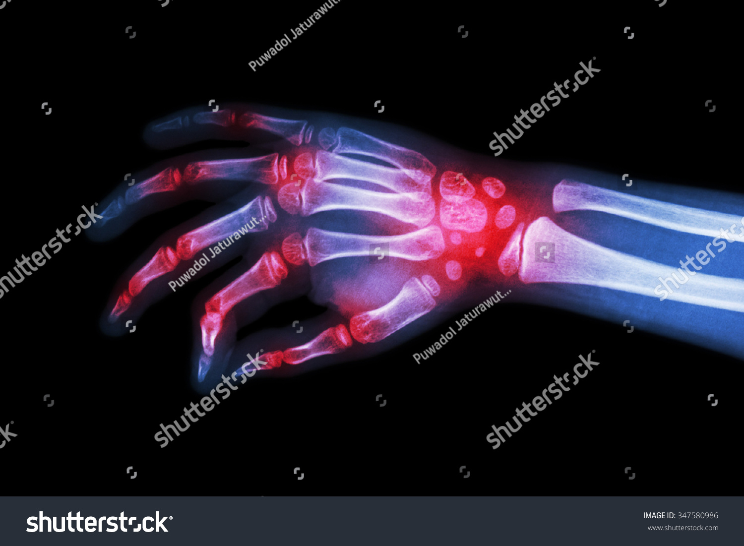 Arthritis imaging Stock Photos, Images & Photography | Shutterstock