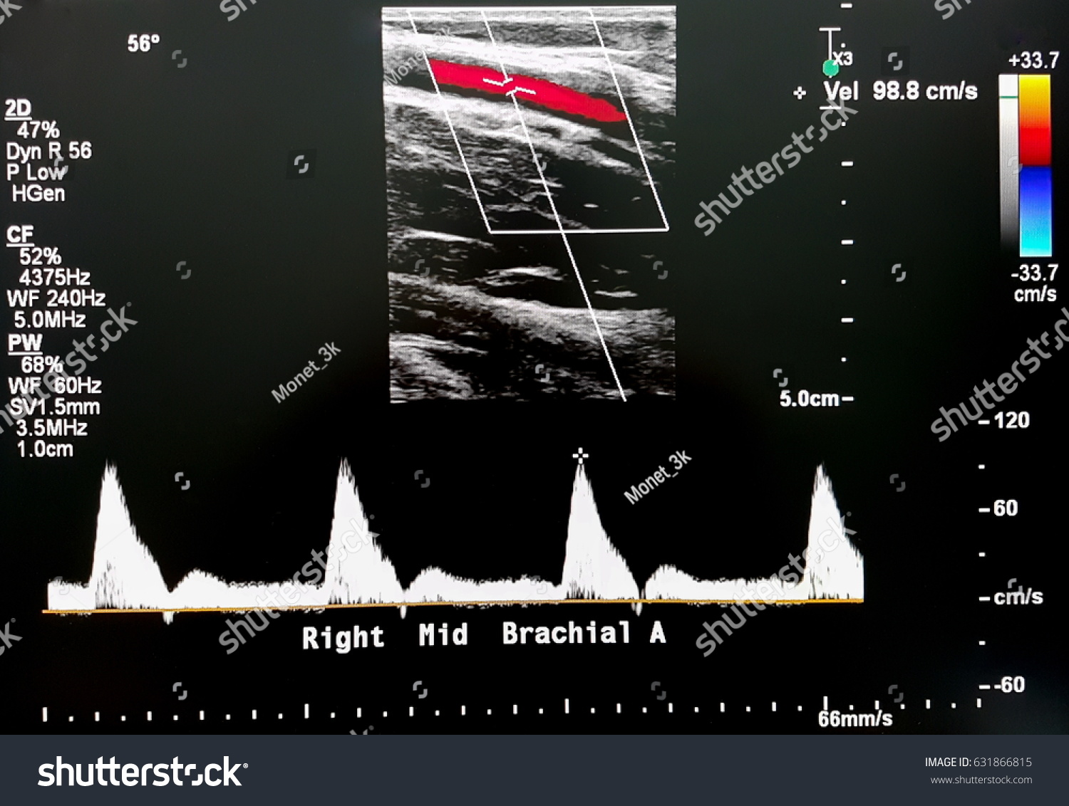 Right Middle Brachial Artery Stock Photo 631866815 | Shutterstock