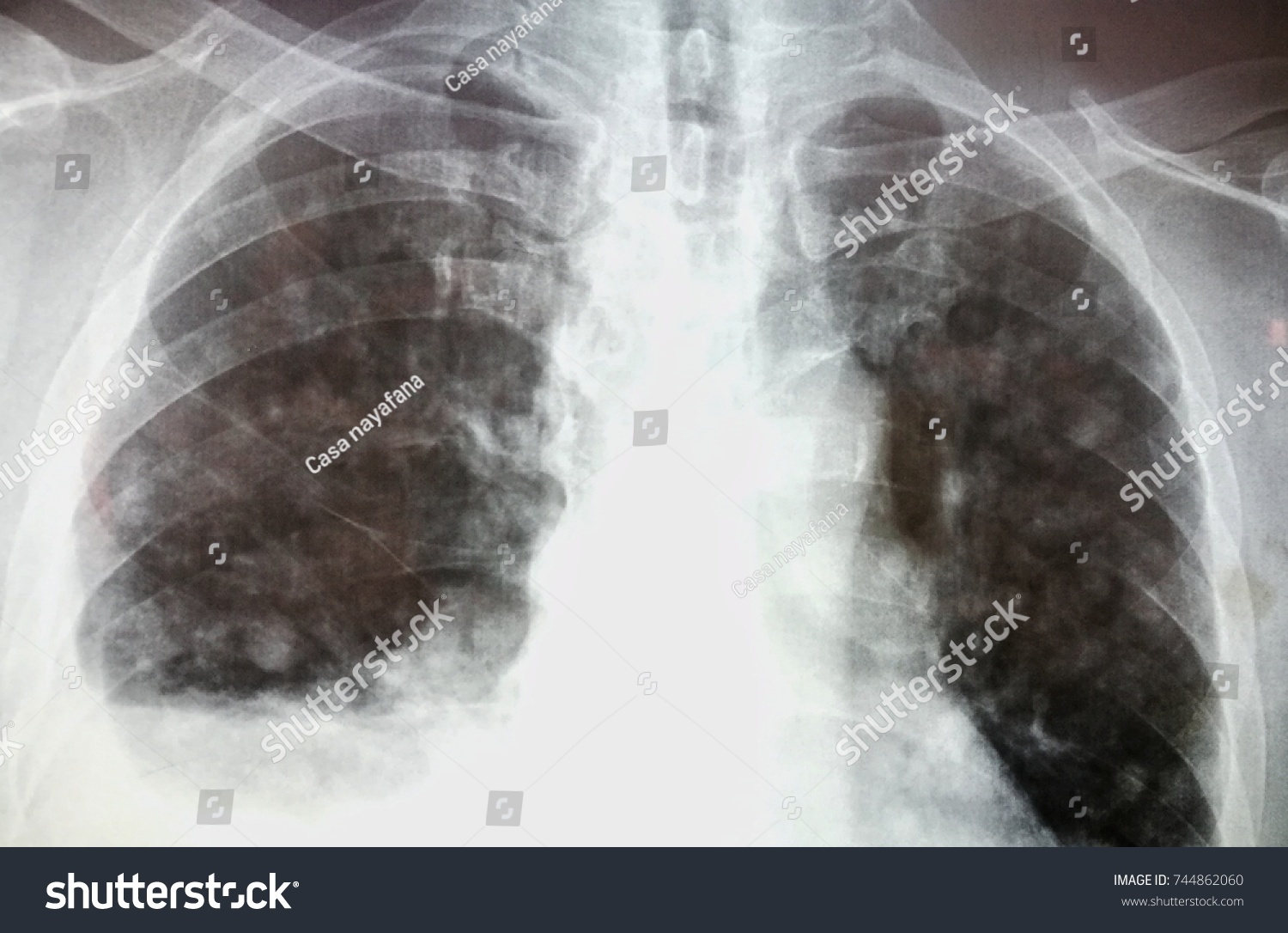 Right Pleural Effusion Multiple Canon Ball Stock Photo 744862060 ...