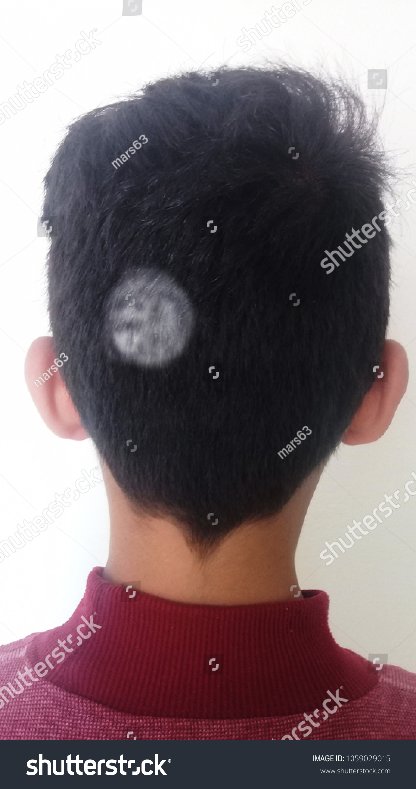 Ringworm Hair Loss Hair Loss Stock Photo Edit Now 1059029015