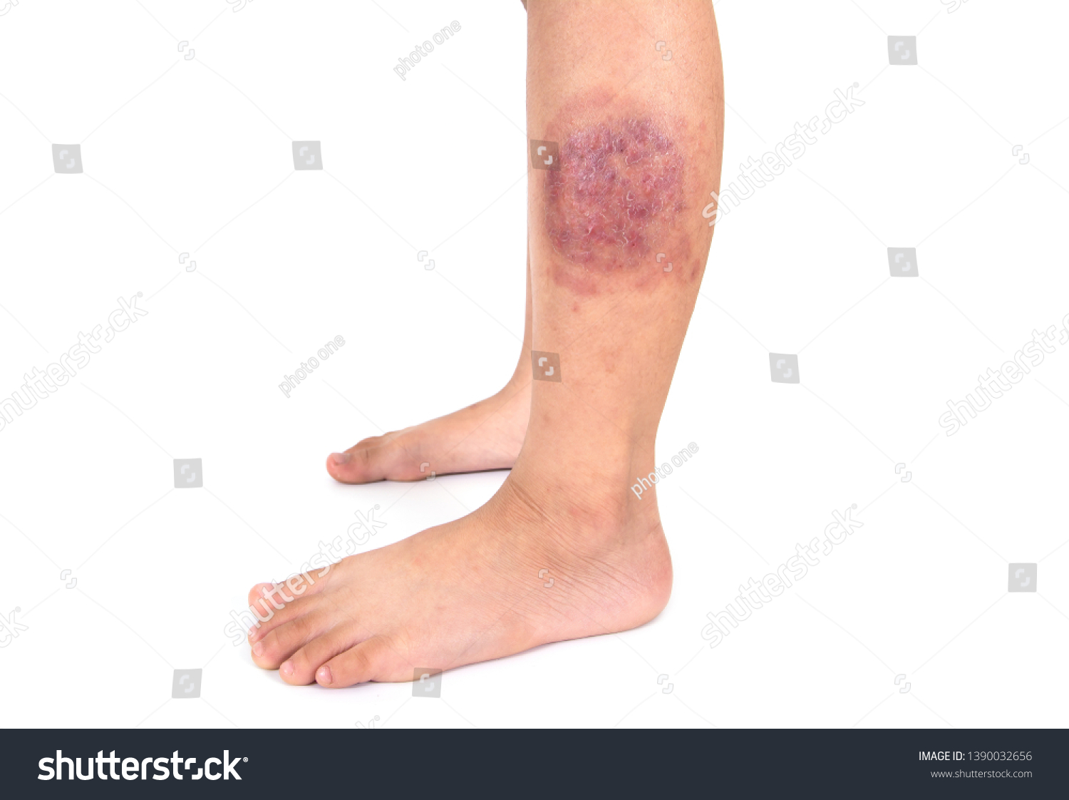 Ringworm Infection Tinea Corporis On Skin Stock Photo 1390032656 ...