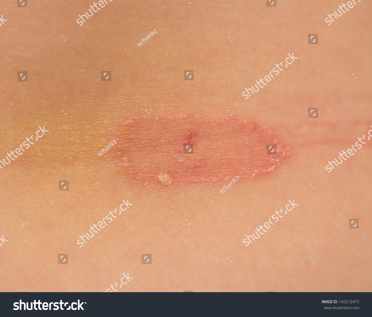 Ringworm Of The Skin. Macro Stock Photo 142212415 : Shutterstock