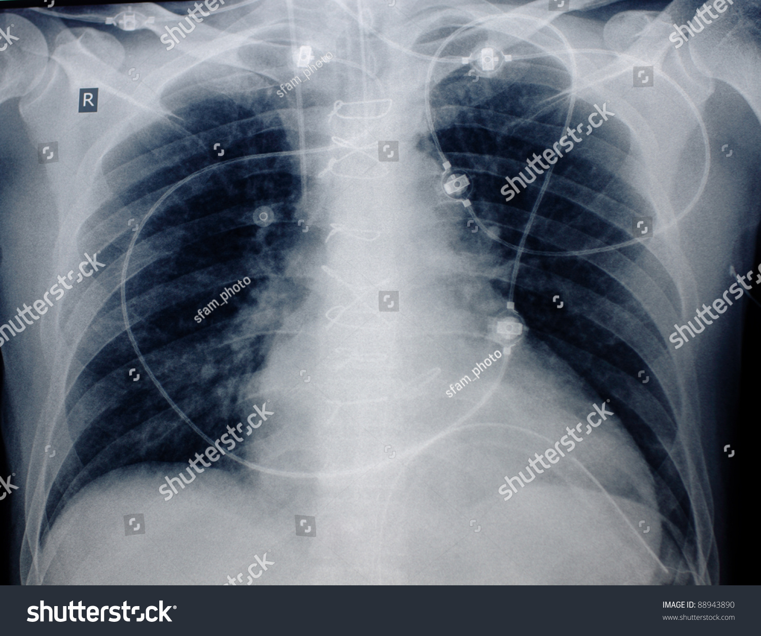 Roentgenogram Of Patient'S Chest After Cardiac Surgery. Visible Wire ...