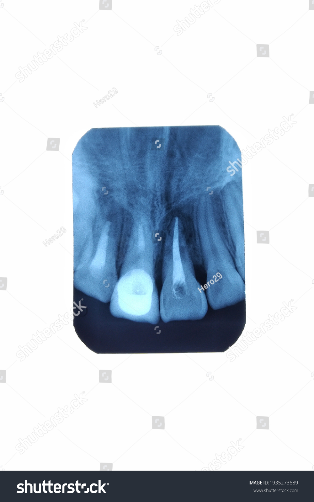 Root Canal Filling Radiology Anterior Teeth Stock Photo 1935273689 ...