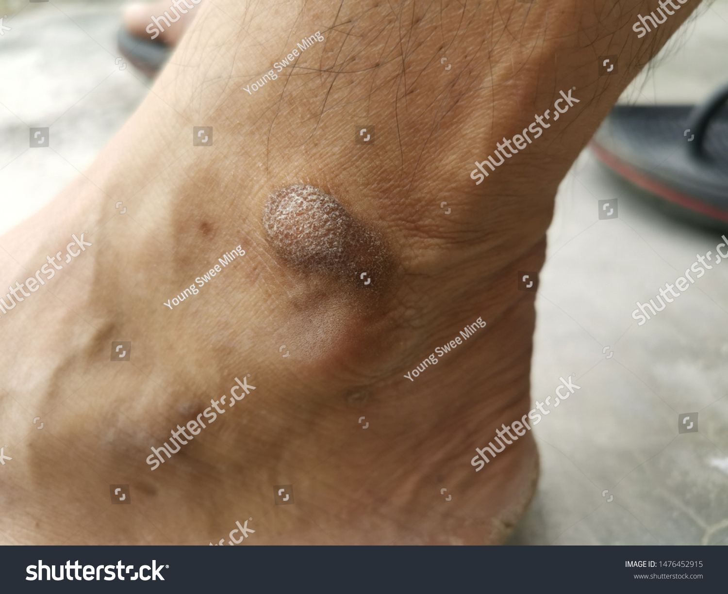 rough skin on foot