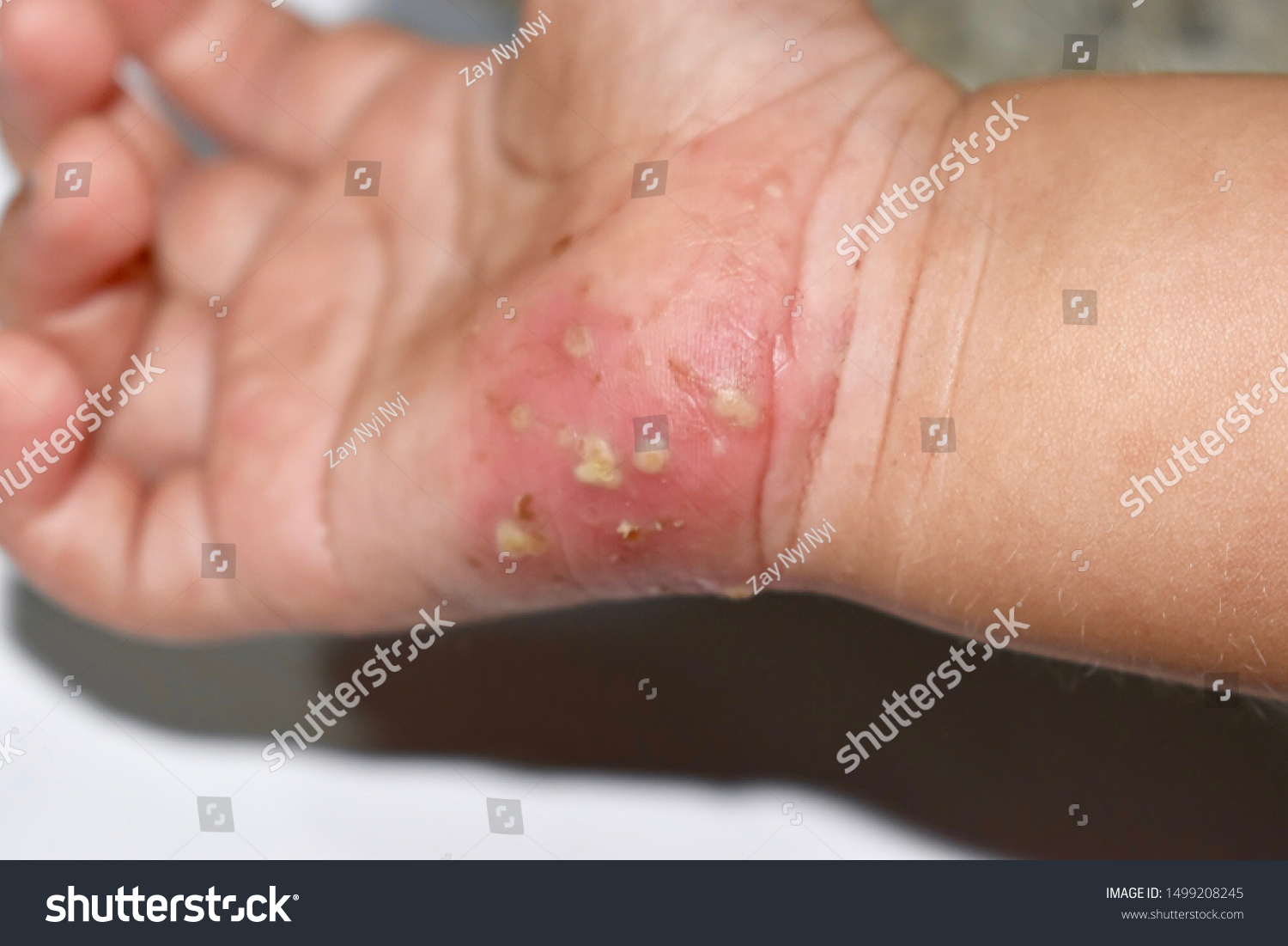 812 Scabies Mite 이미지, 스톡 사진 및 벡터 | Shutterstock