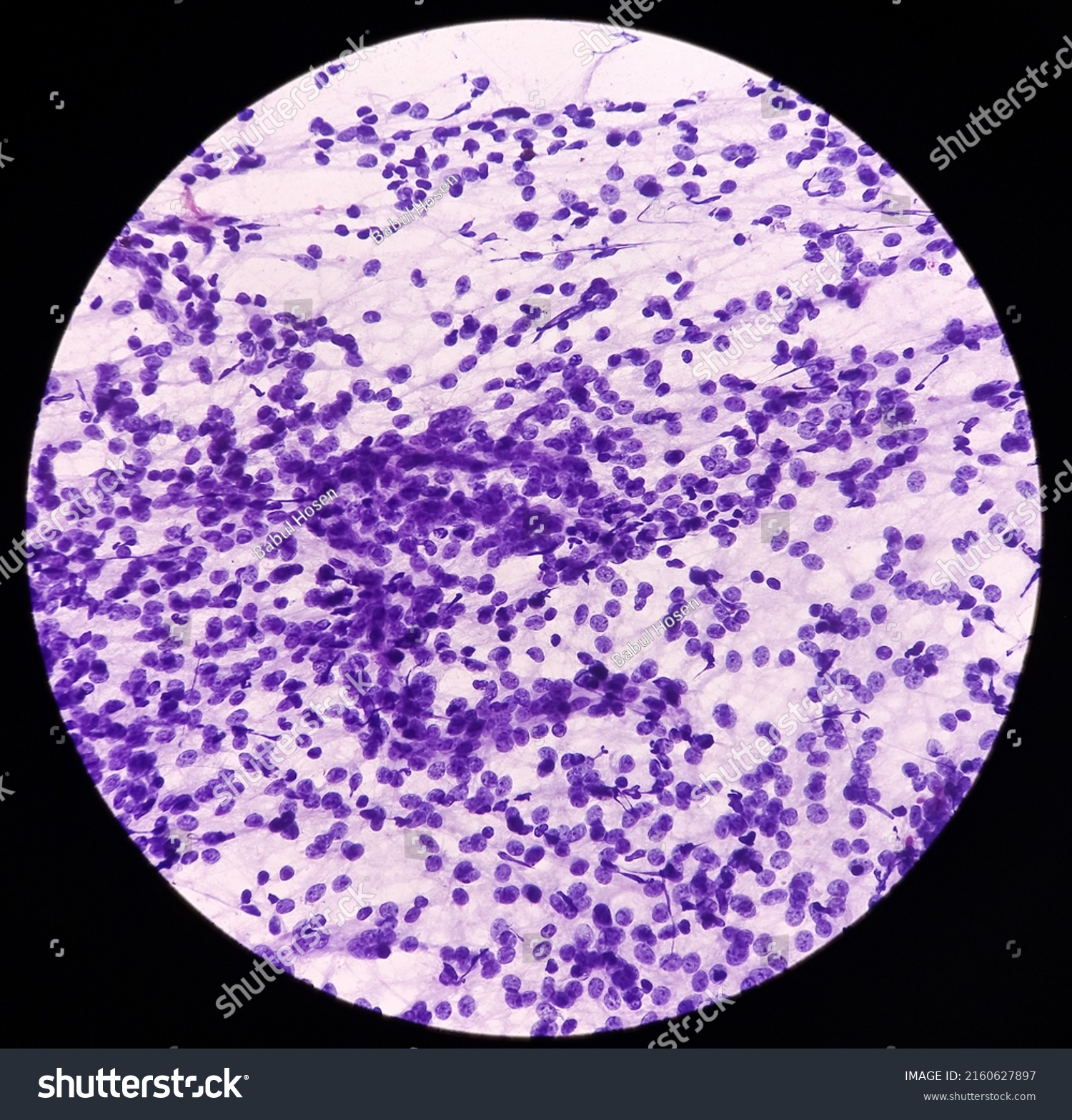 Scar Endometriosisfna Microscopic Image Show Benign Stock Photo ...