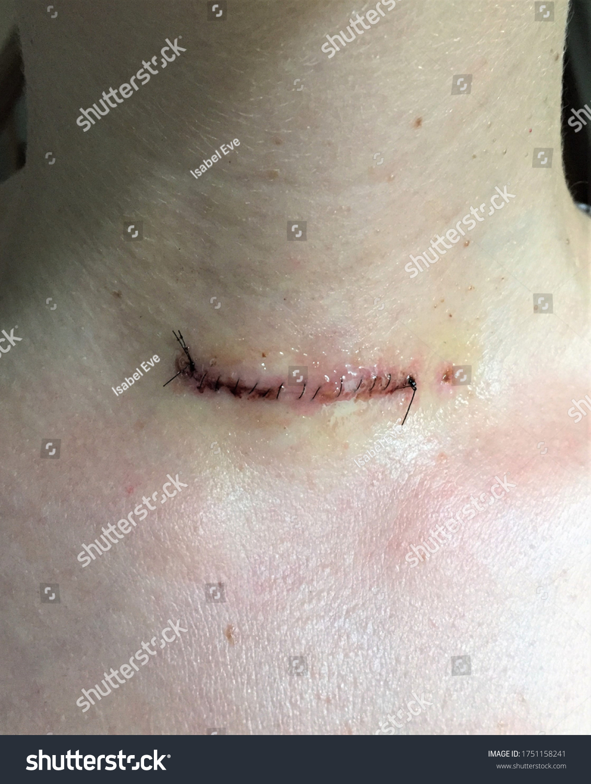 Scar Thyroidectomy Surgery Stitches Still Incision Stock Photo (Edit ...