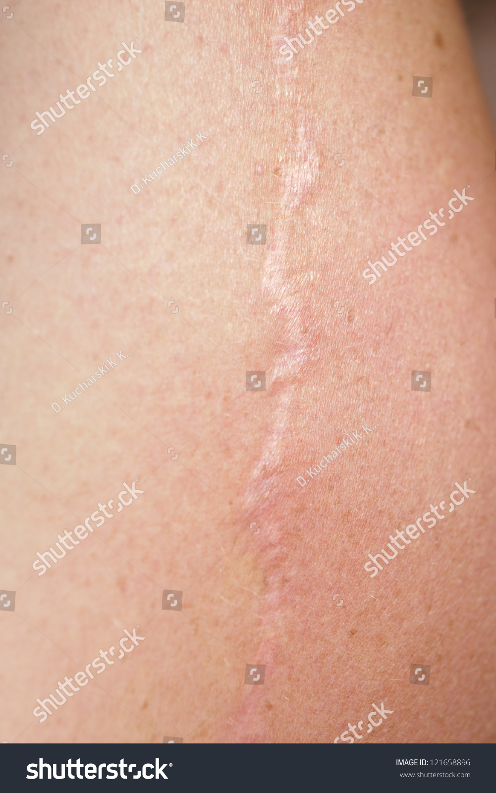 scar on human skin stock photo 121658896 scar on human skin stock photo 121658896 scar on human skin stock photo 121658896 scar on human skin stock photo 121658896