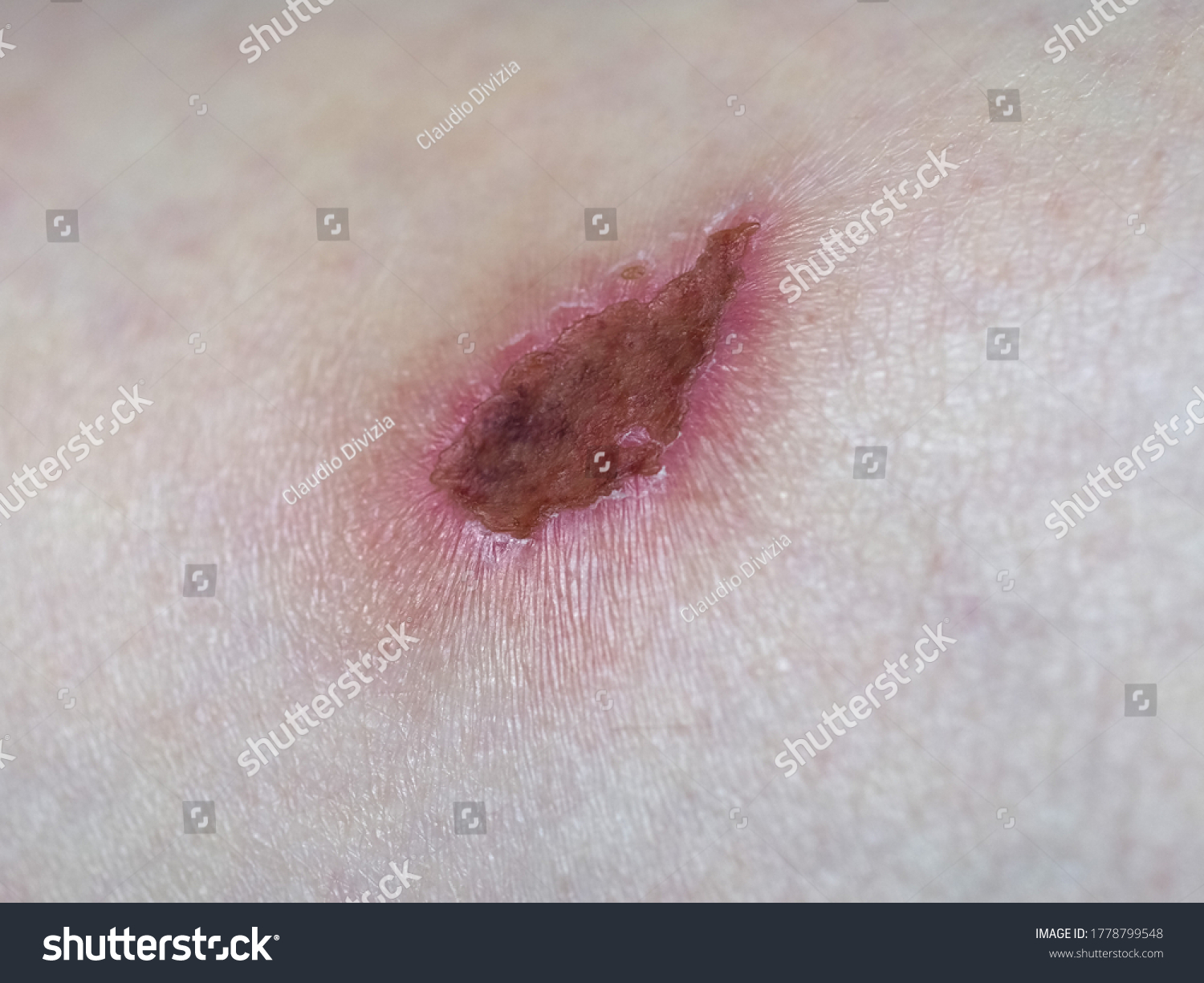 Scar Tissue Following Abrasion Graze On Stock Photo 1778799548 ...