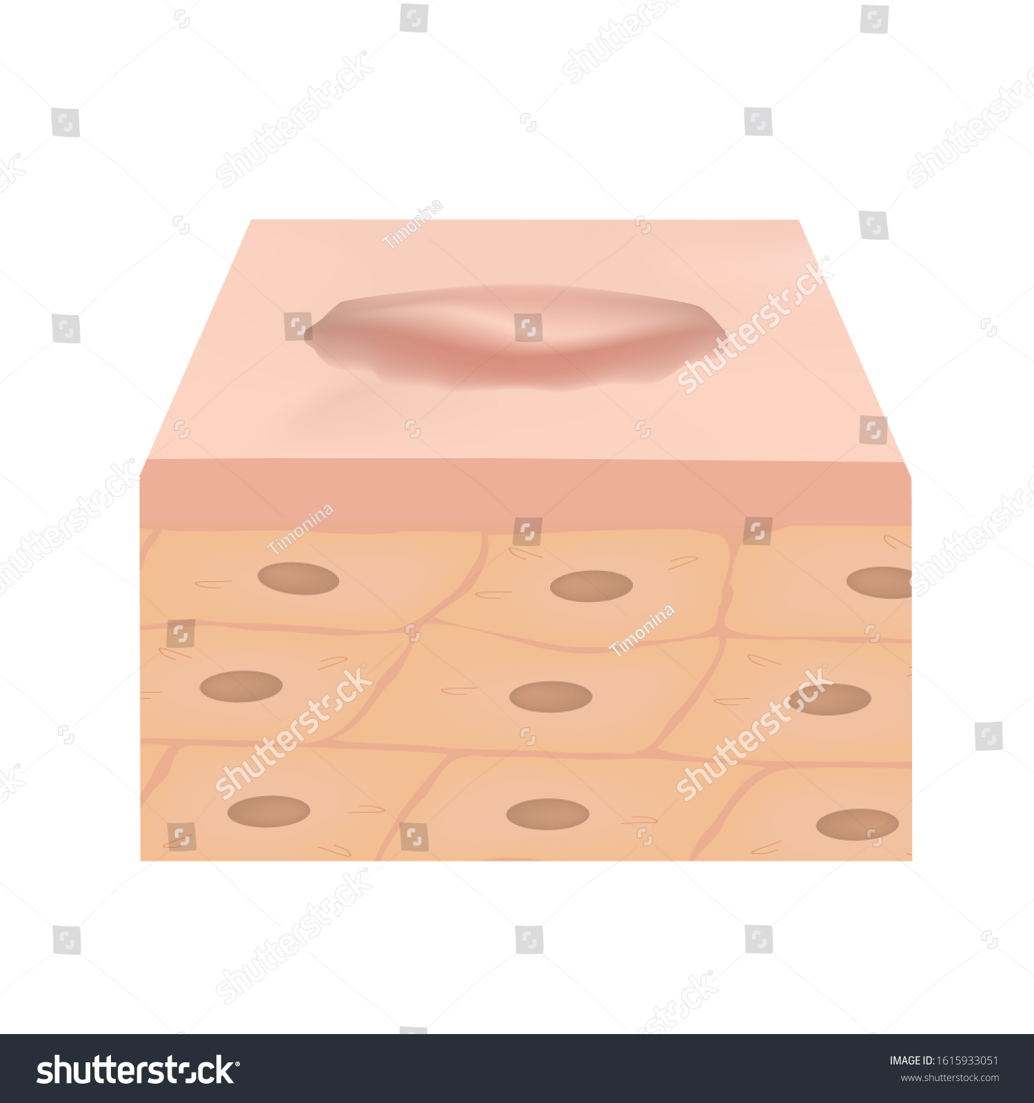 Scars Keloid Anatomical Structure Skin Scar Stock Illustration ...