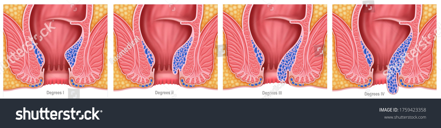 92 Swelling Hemorrhoids Images, Stock Photos & Vectors 