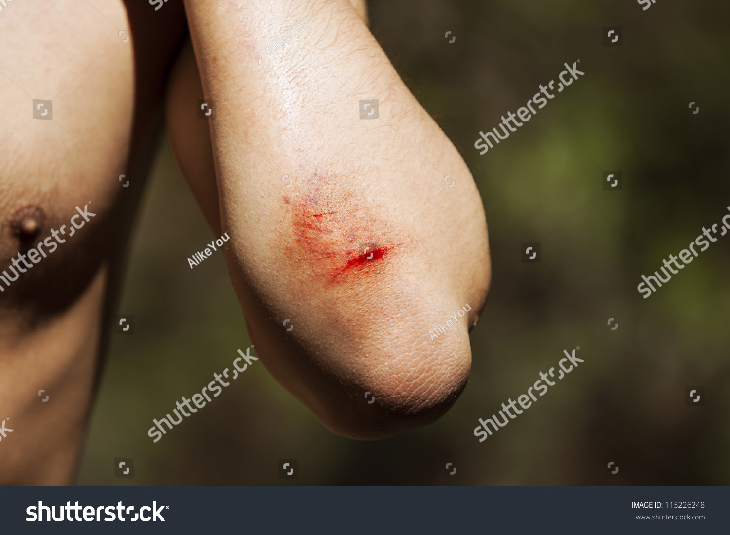 scratched-wound-on-elbow-stock-photo-115226248-shutterstock