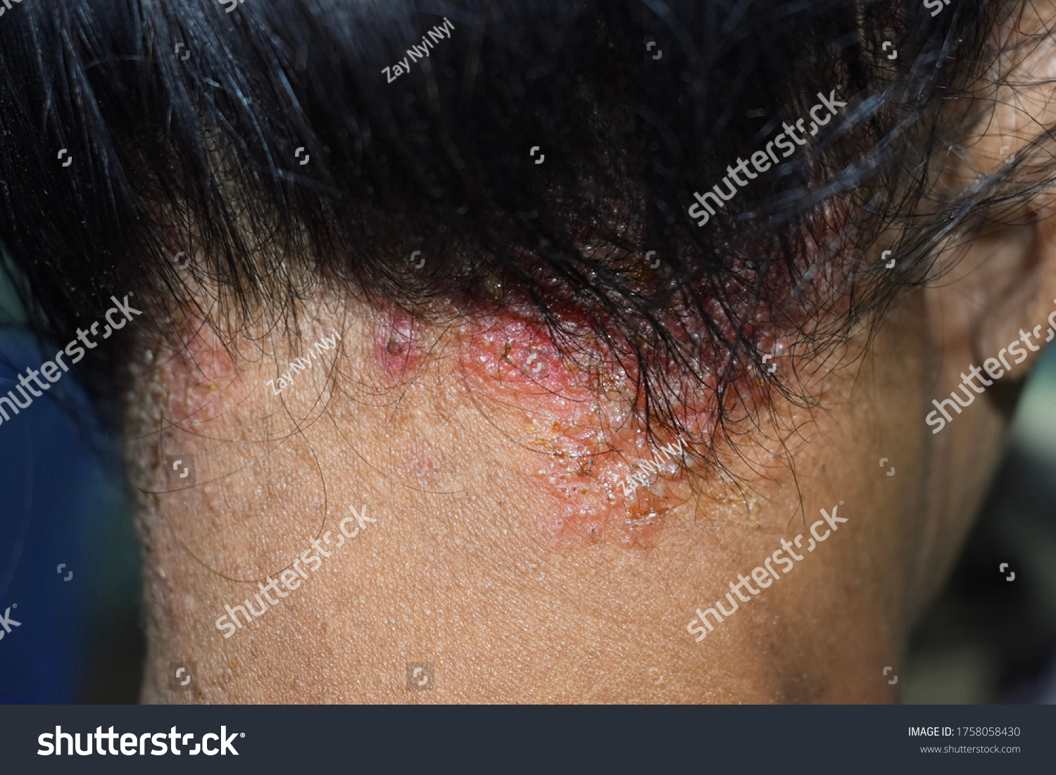 Seborrheic Dermatitis Fungal Skin Infection Scalp Stock Photo Edit Now ...