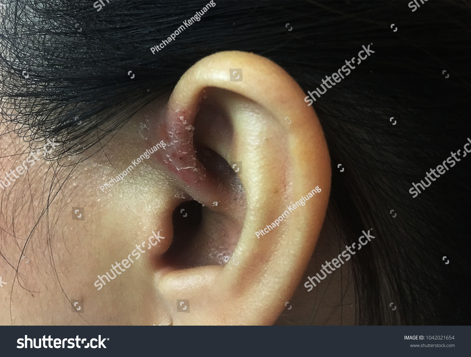 Seborrheic Dermatitis Where Ear Feels ItchyẢnh Có Sẵn1042021654 Shutterstock