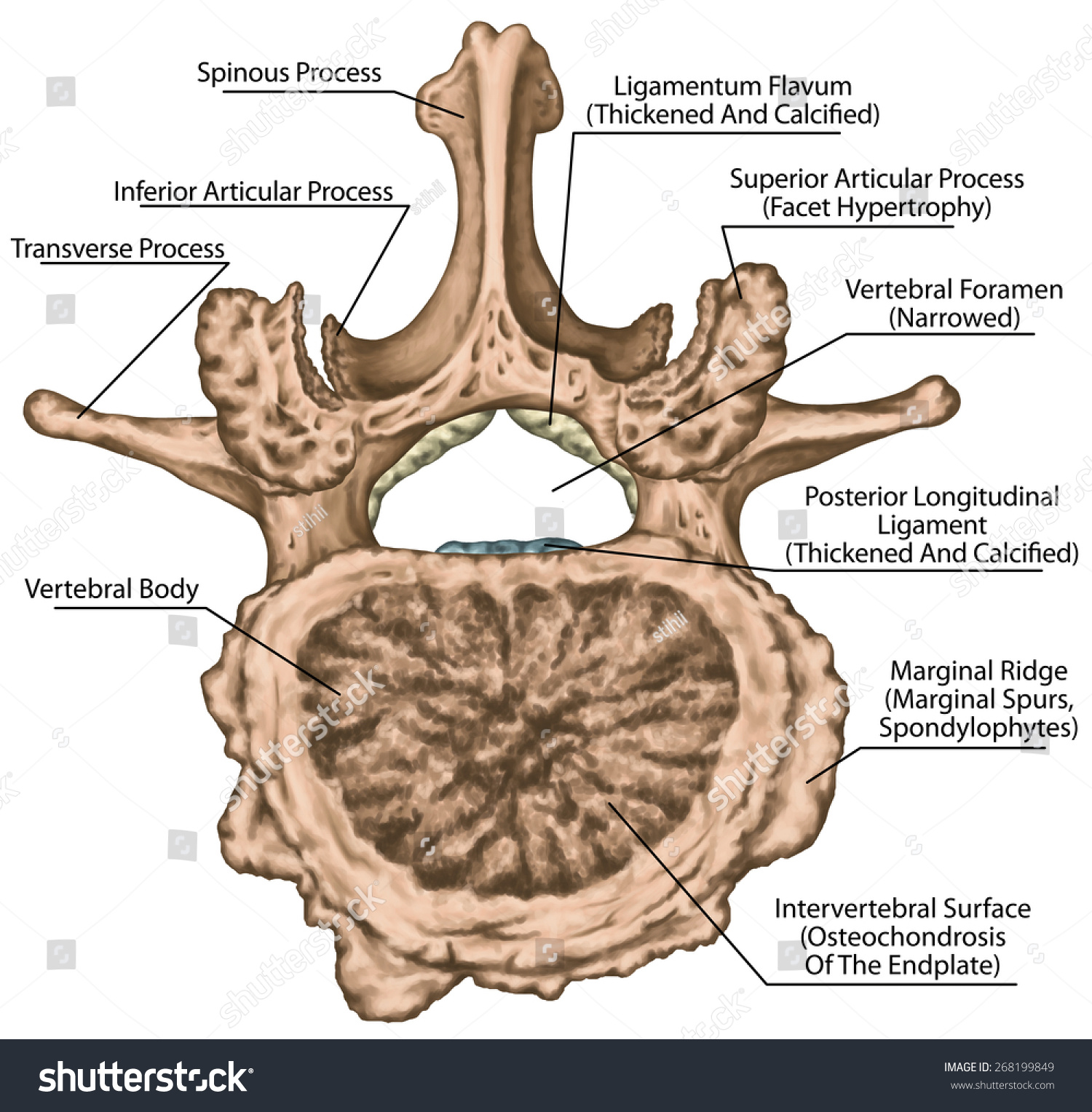 Second Lumbar Vertebra, Lumbar Spine,Vertebra, Advanced Uncovertebral ...