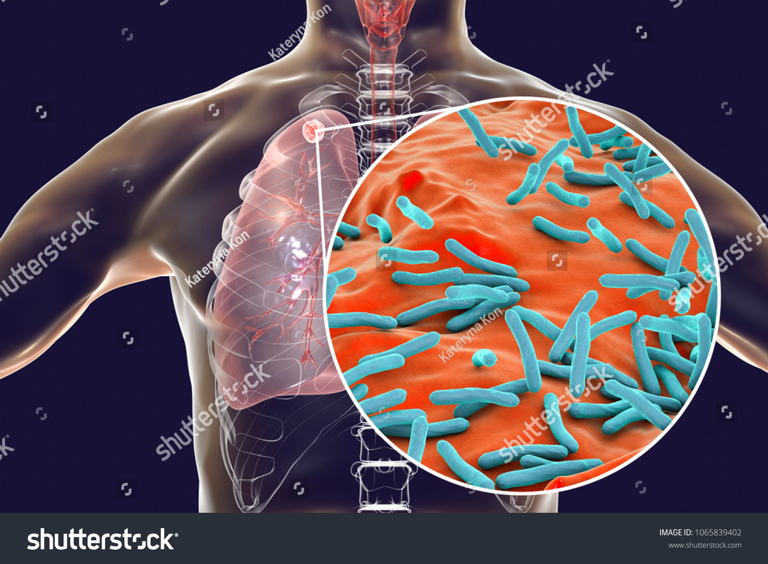 Secondary Tuberculosis Lungs Closeup View Mycobacterium Stock ...