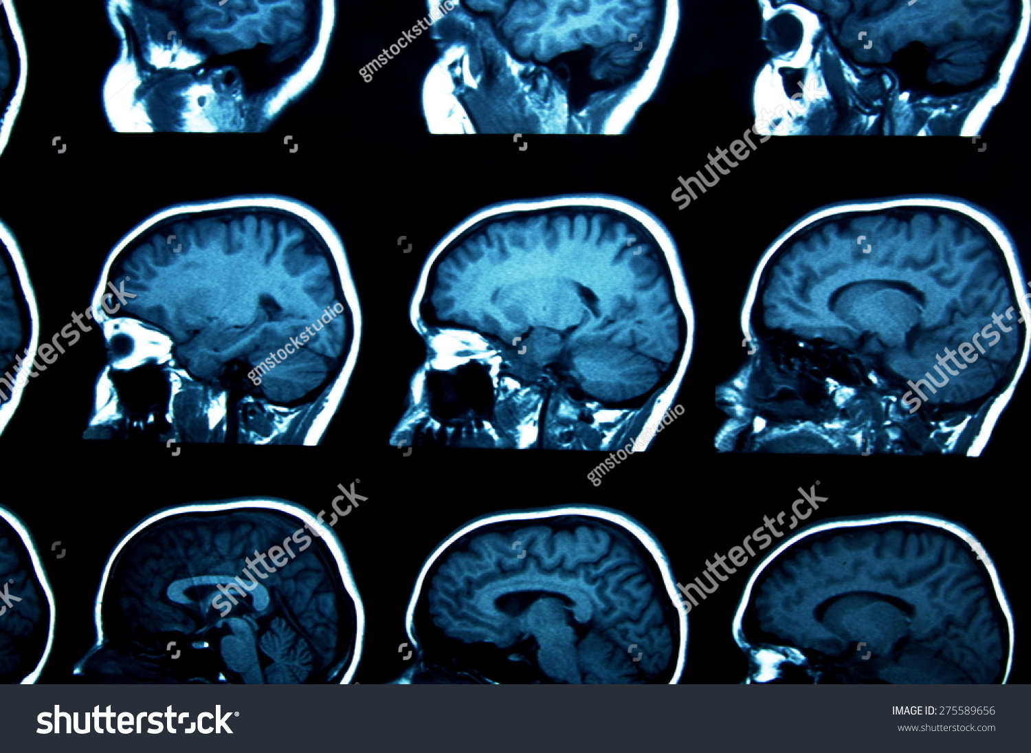 Set Of Mri Scans On Black Stock Photo 275589656 : Shutterstock