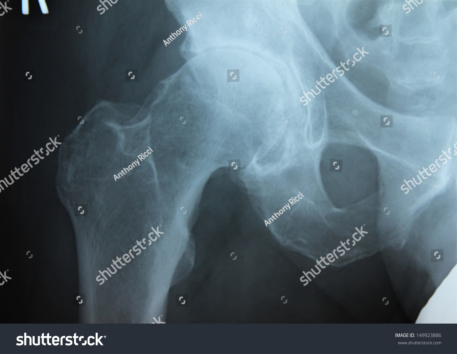 Severe Osteoarthritis Right Hip 58 Year Stock Photo 149923886 ...