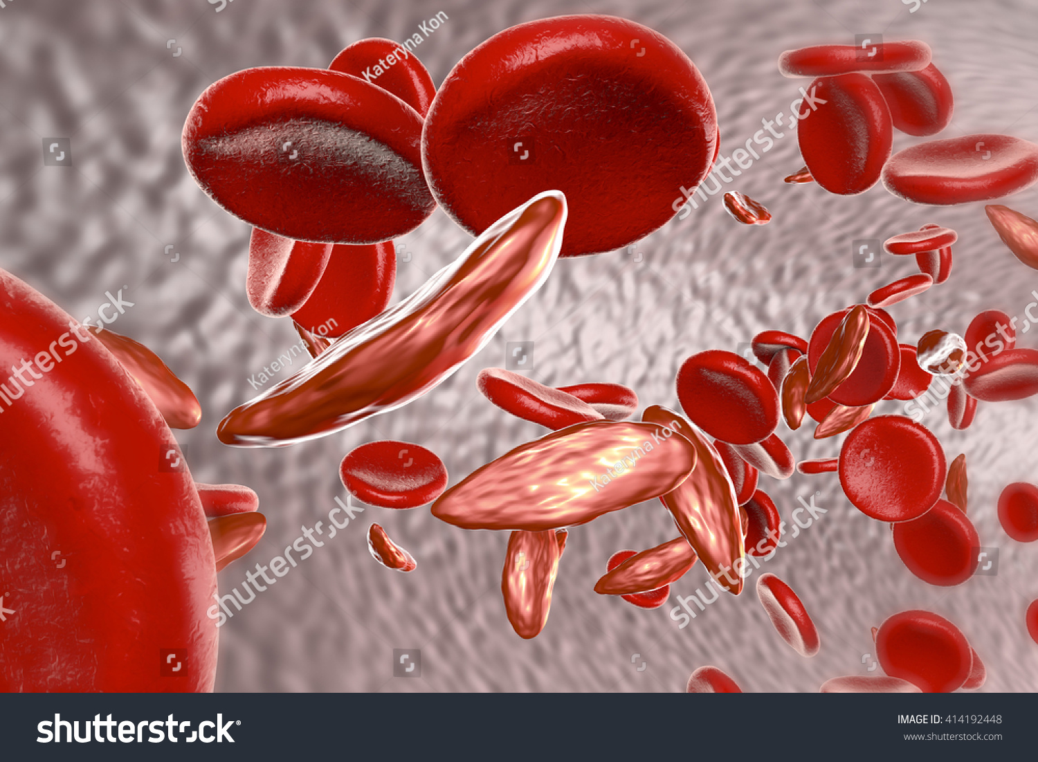 Sickle Cell Anemia 3d Illustration Showing Stock Illustration 414192448 4716