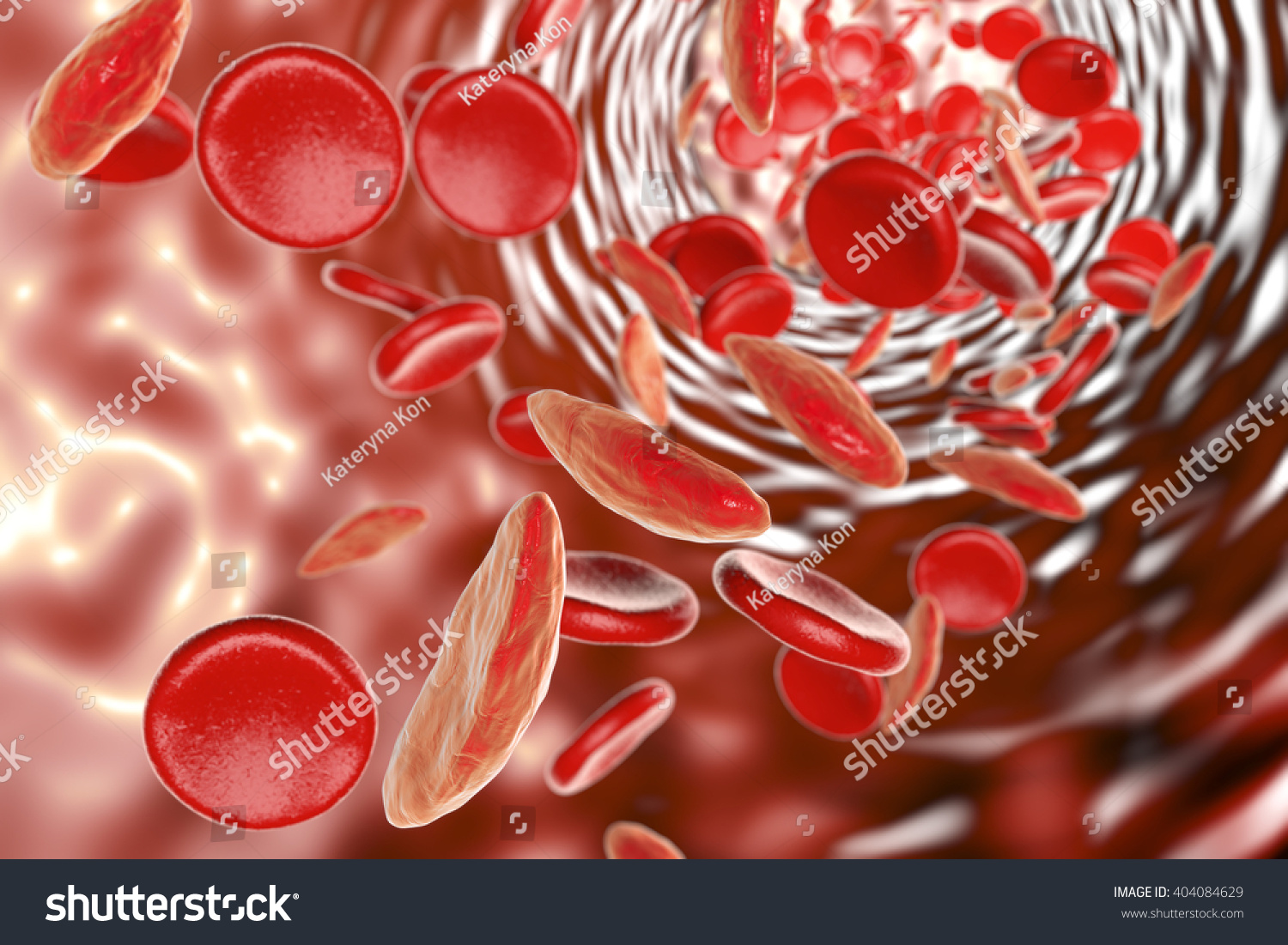 Sickle Cell Anemia 3d Illustration Showing Stock Illustration 404084629 Shutterstock 4161