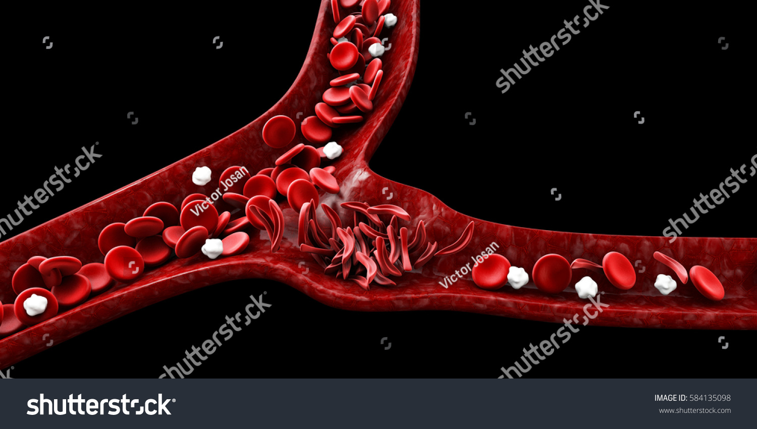 Ilustrasi Stok Sickle Cell Anemia 3d Illustration Showing 584135098 Shutterstock 6980