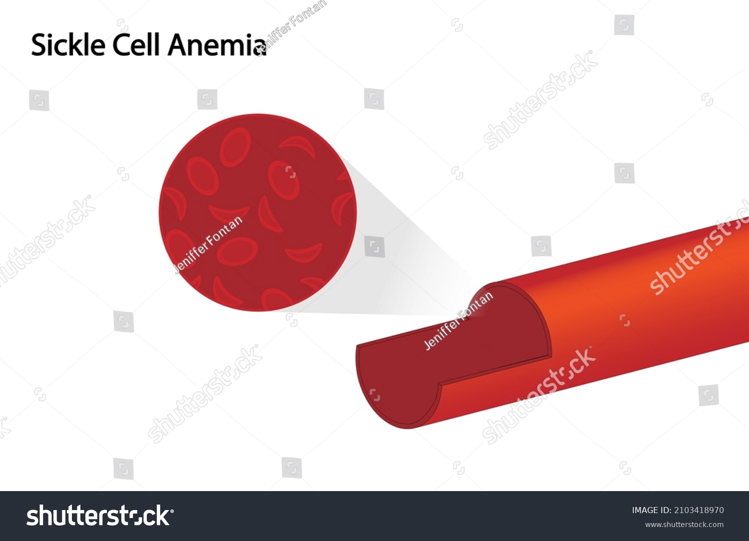 Sickle Cell Anemia Illustration Hemoglobin Sickle Stock Illustration 2103418970 3553