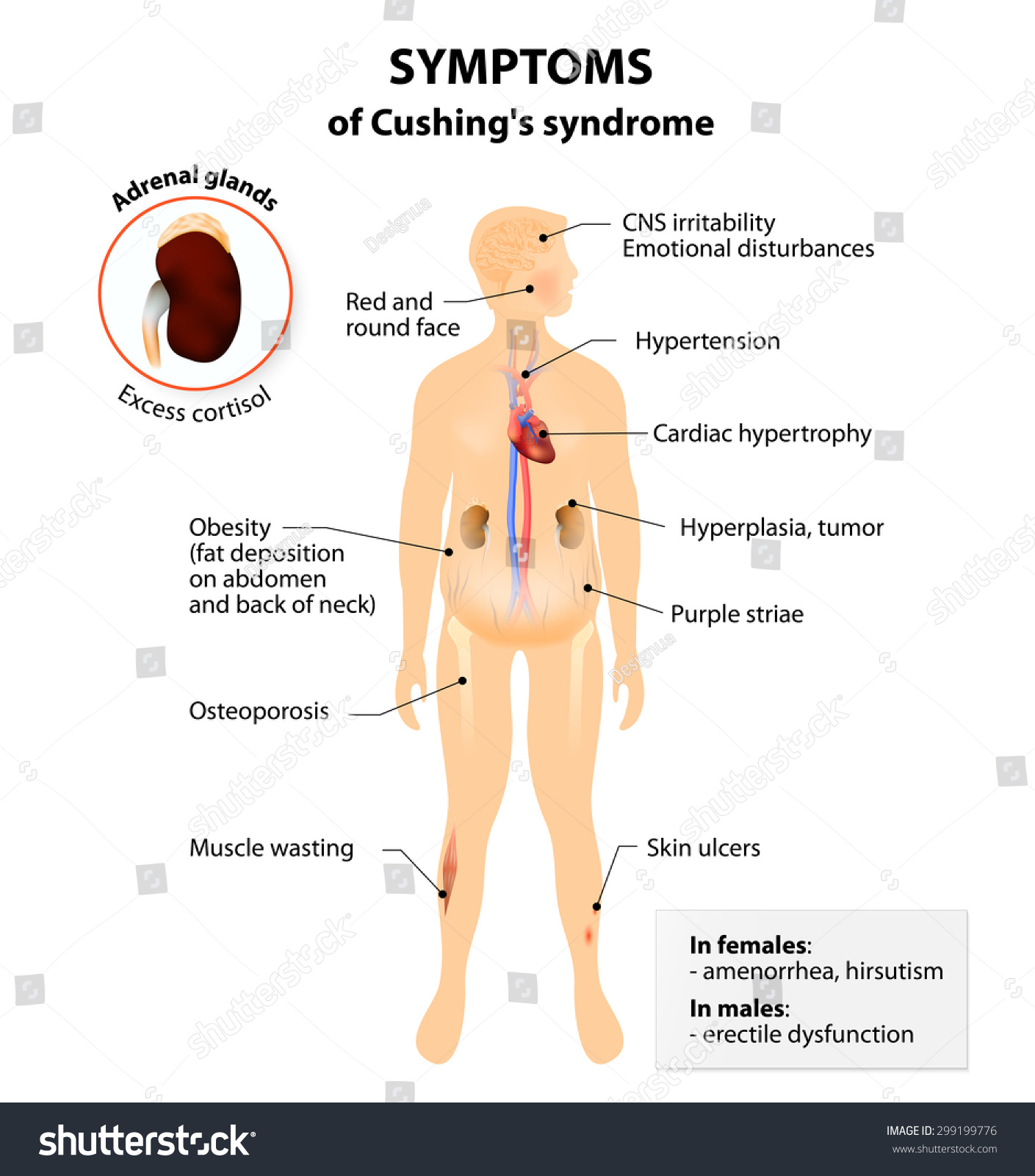 Signs Symptoms Cushings Syndrome Labeled Human Illustrazione Stock 299199776 Shutterstock 