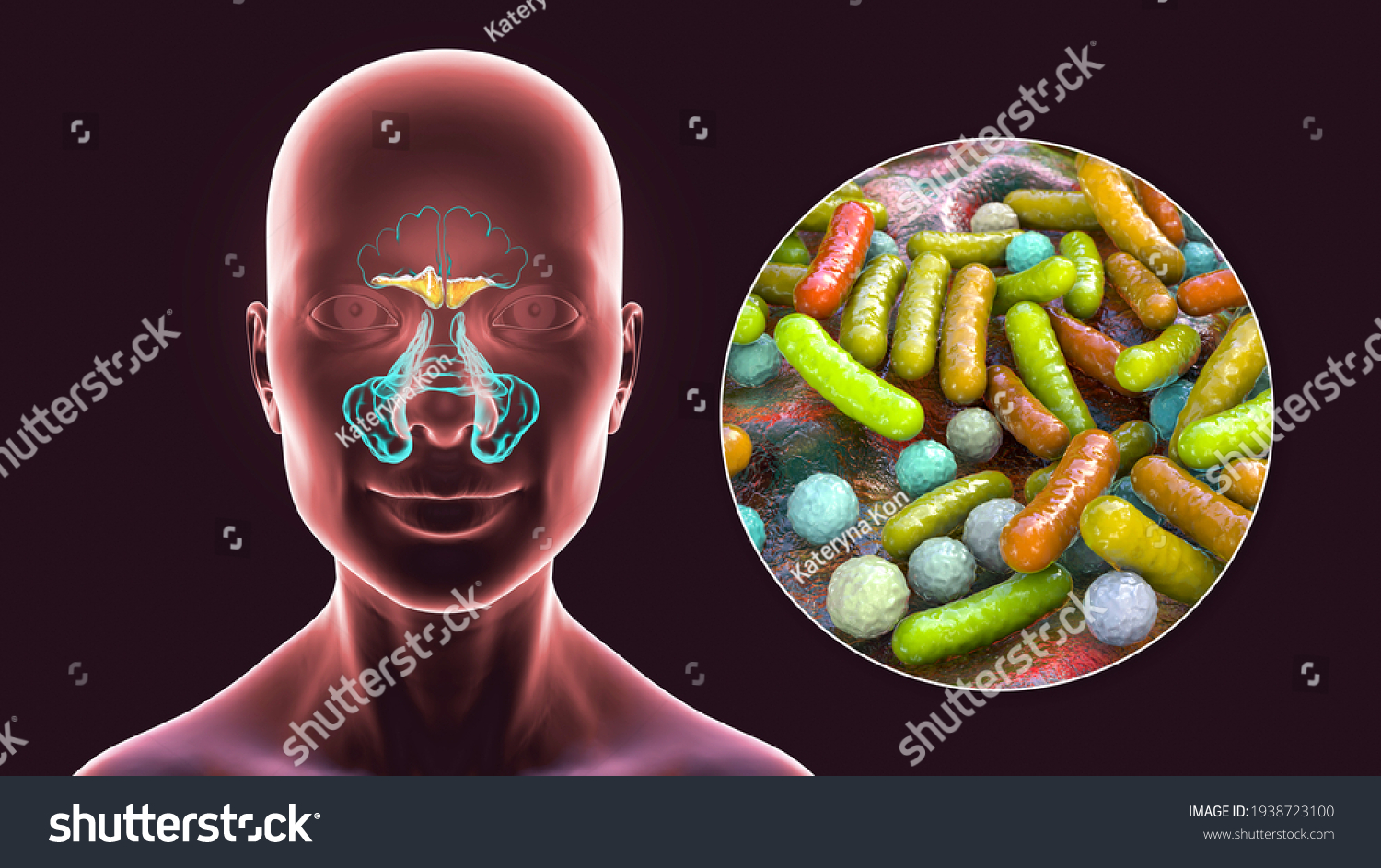 Sinusitis Inflammation Paranasal Cavities 3d Illustration Stock Illustration 1938723100