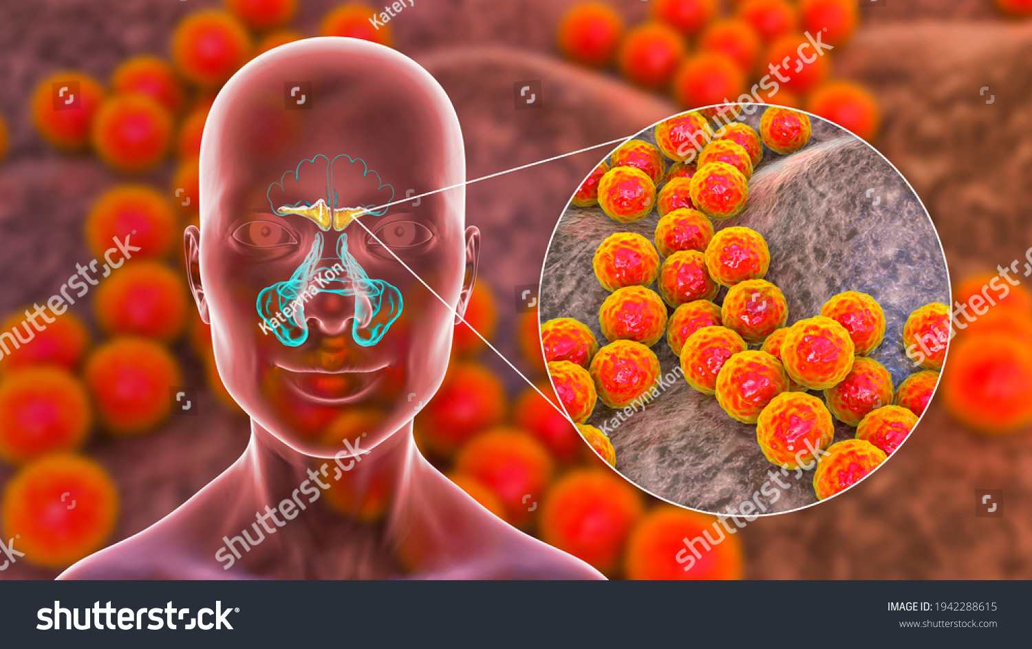 Sinusitis Inflammation Paranasal Cavities 3d Illustration Stock ...