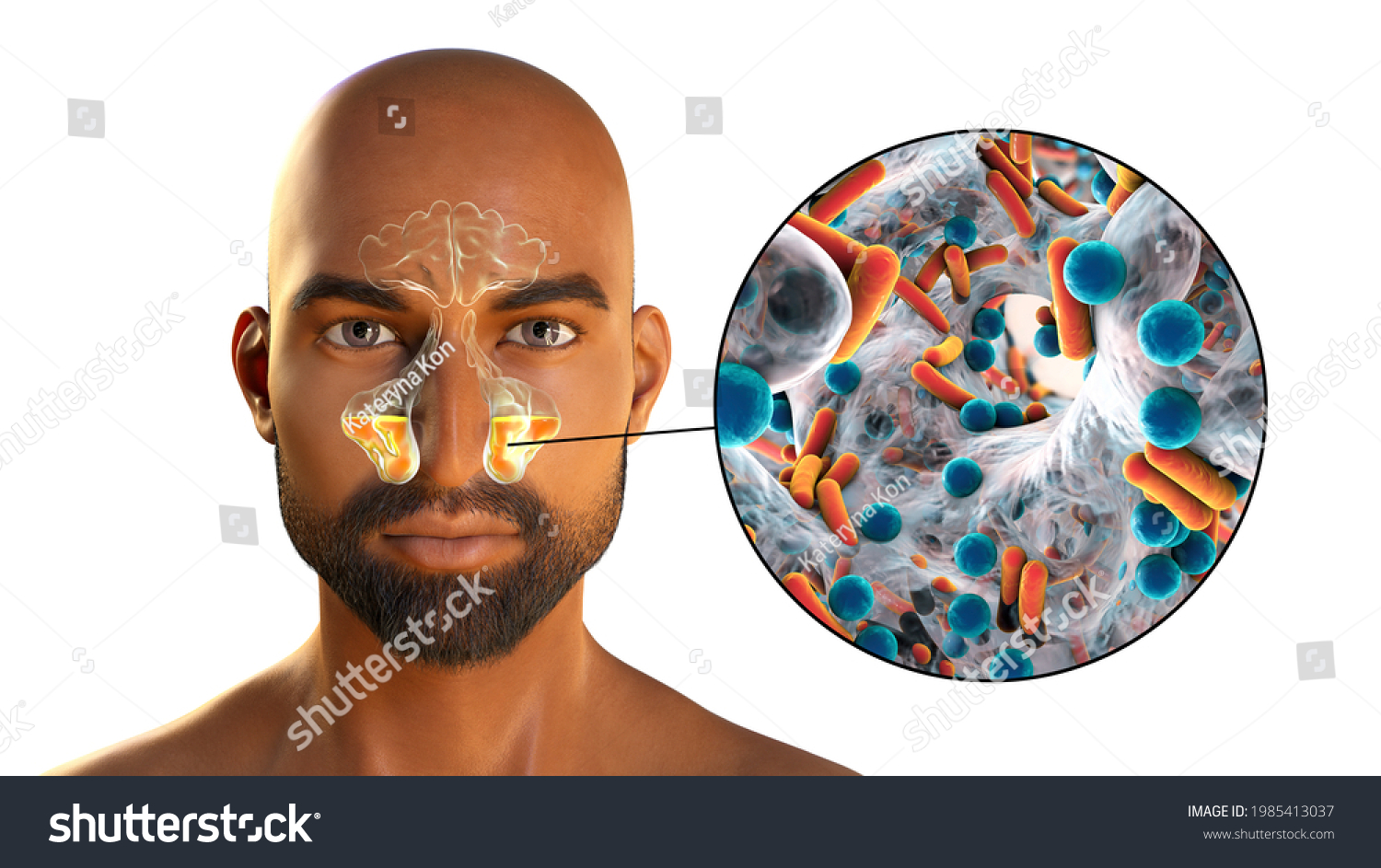 Sinusitis Inflammation Paranasal Cavities 3d Illustration Stock ...