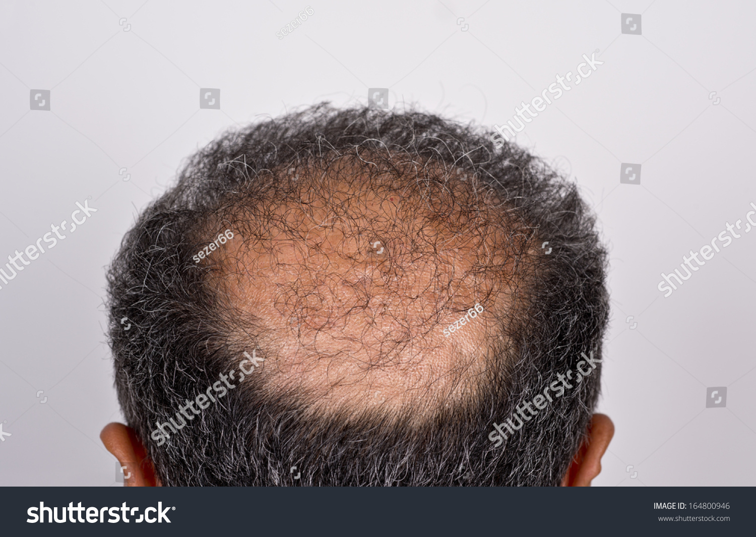 50 Hair Transplant Failure Images Stock Photos Vectors Shutterstock 50 Hair Transplant Failure Images Stock Photos Vectors Shutterstock