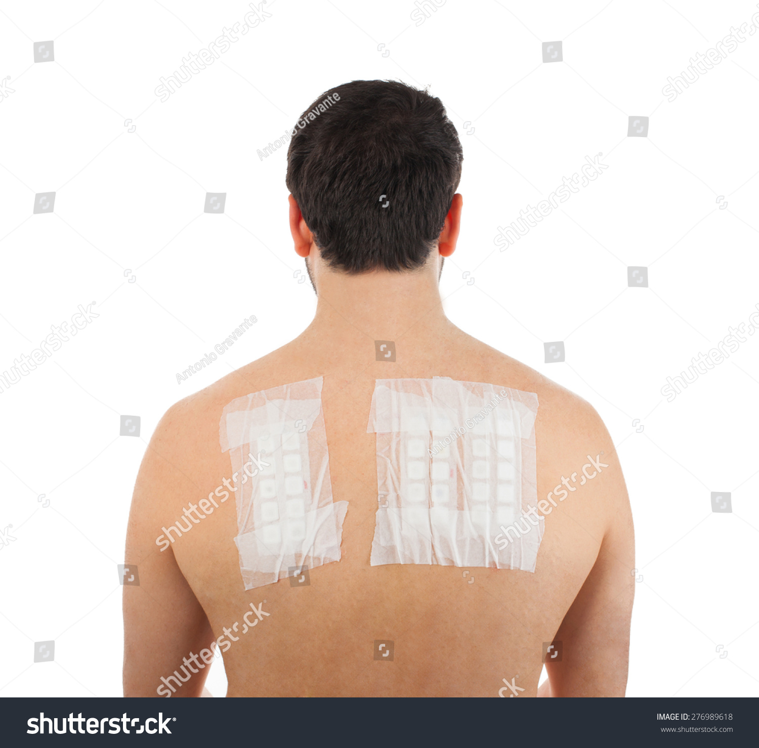 Skin Allergy Patch Test On Back Stock Photo 276989618 | Shutterstock