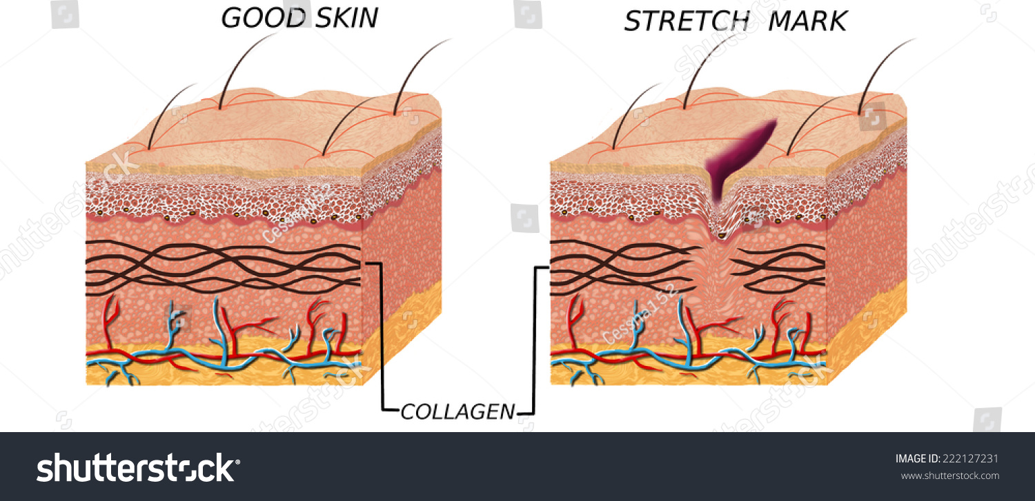 Skin Anatomy Diagram - Comparation Good Skin And Skin Witch Stretch ...