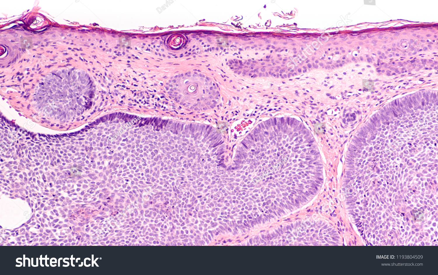 Skin Biopsy Pathology Basal Cell Carcinoma Foto Stock 1193804509